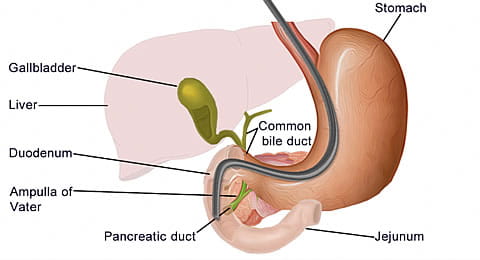 BEST ERCP TREATMENT